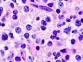Anaplastický oligodendrogliom při větším zvětšení, barvení hematoxylin-eosin