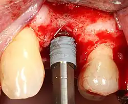 Do osteotomie se natočí přípravek pro implantát. V ideálním případě je zcela zakrytý kostí a v kosti se nepohybuje.