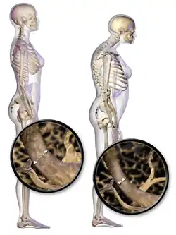 Porovnání normálního držení těla a držení těla ovlivněného osteoporózou.