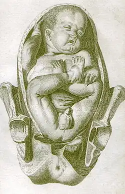 Kresba přímého porodu koncem pánevním z roku 1754 od William Smellieho