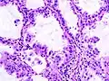 Histologický preparát karcinomu produkujícího mucin (barvení hematoxylin-eosinem)