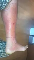Cellulitis nohy a chodidla