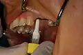 Celokeramický implantát z jednoho kusu