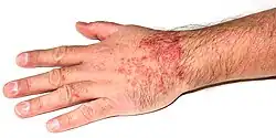 Cerkáriová dermatitida vyvolaná druhem Trichobilharzia szidati