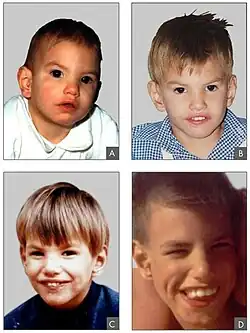 Pacient postižený syndromem Cri du chat ve věku: A) 8 měsíců, B) 2 let, C) 4 let a D) 9 let