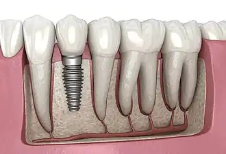 zubní implantát
