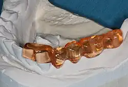 Pro usnadnění umístění implantátů se chirurgovi zhotoví vodítko (obvykle z akrylu), které ukazuje požadovanou polohu a úhel implantátů.
