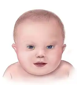 Ilustrace obličejových rysů u Downova syndromu