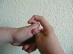 Ukázka hypermobility kloubu u EDS