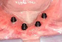 Čtyři mandibulární implantáty