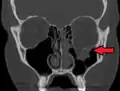 Zlomenina spodiny očnice (blow-out fracture)