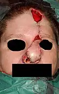 Axiální lalok (forehead-flap) k rekonstrukci nosu