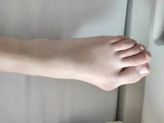 Hallux valgus, girl 13 years old, Czech Republic 2.jpg