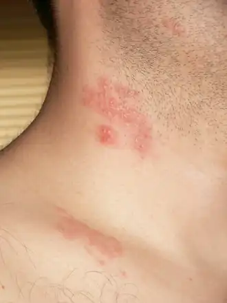 Pásový opar na krku.