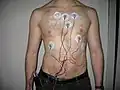 EKG Holter se sedmi elektrodami. Lze si také všimnout, že pacientova místa, kde dochází ke styku elektrod s kůží, jsou řádně oholena.