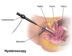 Hysteroskopie
