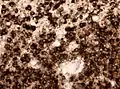 IDH1 R132H u anaplastický oligodendrogliom