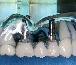 Fixní částečná zubní náhrada (FPD) s implantáty