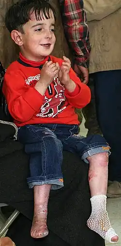 Pětiletý chlapec s vrozenou epidermolysis bullosa