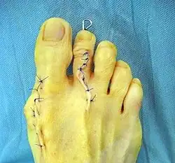 Hallux valgus (po operaci)