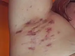 Hidradenitis suppurativa