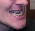 Mandibulární progenie