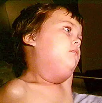 Dítě s projevy příušnic