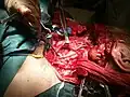 Krční disekce – onkochirurgická operace spádových uzlin