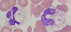 Neutrofily s intracelulárními bakteriemi (diplokoky) v nátěru periferní krve.