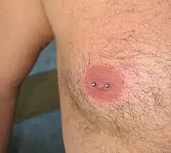 Nipple