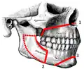 Korekce čelistních anomálií: linie osteotomií: Le Fort I, BSSO, genioplastika (ortognátní chirurgie)