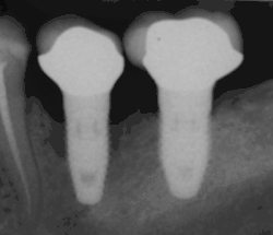 Periimplantitida