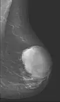 Cystosarcoma phylloides, nádor prsu