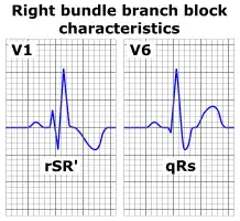 EKG nález u BPRTw