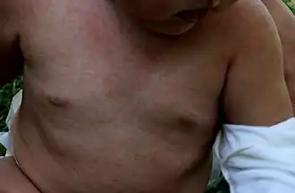 Vyrážka provázející šestou nemoc.