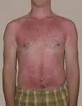 Úžeh je typickou popáleninou prvního stupně