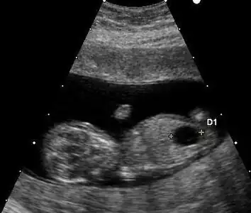 Ultrazvuk plodu s Downovým syndromem ukazující velký močový měchýř