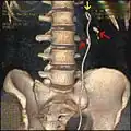 Rekonstruovaný 3D obraz z CT ureterálního stentu v levé ledvině (zvýrazněno žlutou šipkou). Jeden ledvinový kámen se nachází v močovodu (nižší červená šipka) a jeden v ledvině (vyšší červená šipka).